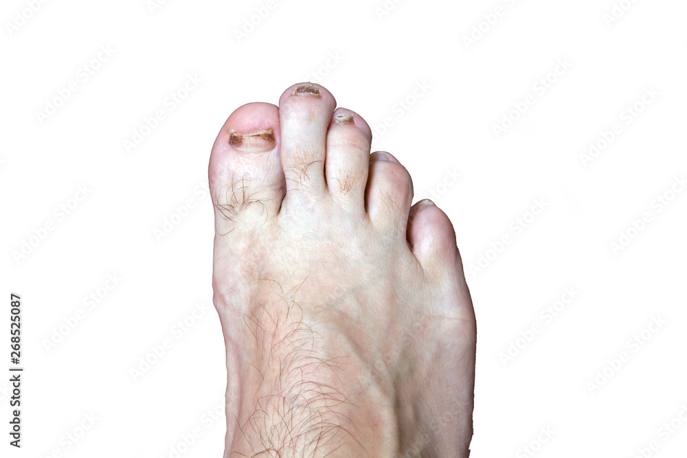 Fototapeta premium Front of man's foot with damaged nails from wearing tight shoes