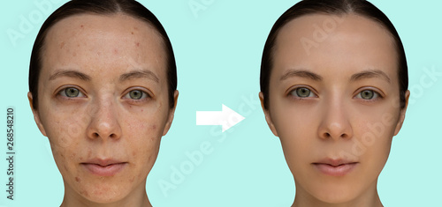 Face of a young girl after a cosmetic procedure of chemical peeling close-up. The concept before and after. © Liliia