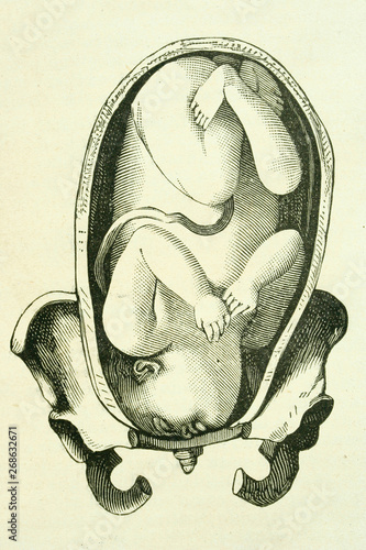 Anomalous position of fetus. Antique illustration. Medicine book. 1889.