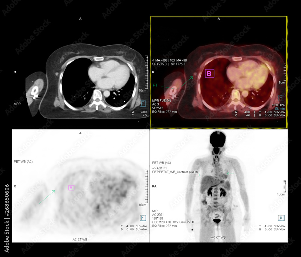 PET CT Scan image of whole body comparison Axial plane in CT scan and