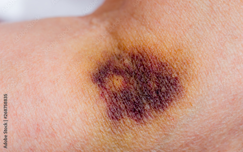 A strong hematoma due to a wrong injection. Concept medical mistakes