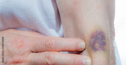 A strong hematoma due to a wrong injection. Concept medical mistakes. photo