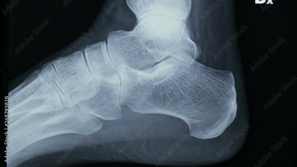 Tibia Zoom Vidéo Stock Zoom-in of the radiographic plate of tibia and fibula and ...