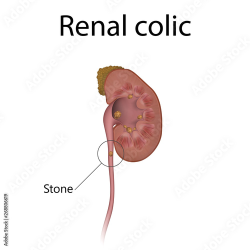 Renal colic, kidney stones. Distended pelvic. Realistic anatomy vector illustration.