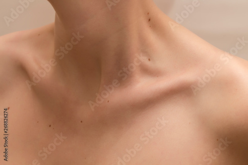 Clavicles and neck of a woman with moles on the skin