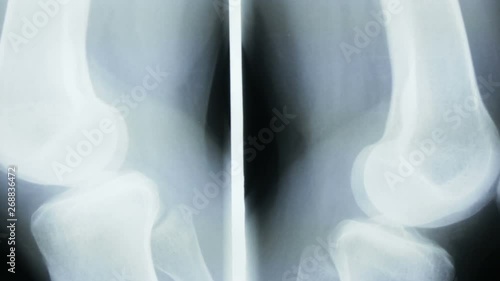 Zoom-in on the x-ray plate of the femur and bones of the human knee, in lateral view. photo