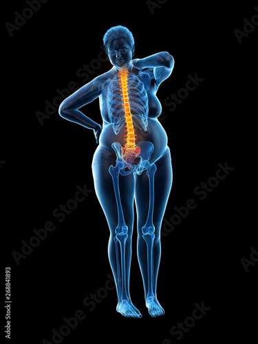 3d rendered medically accurate illustration of an overweight womans painful back