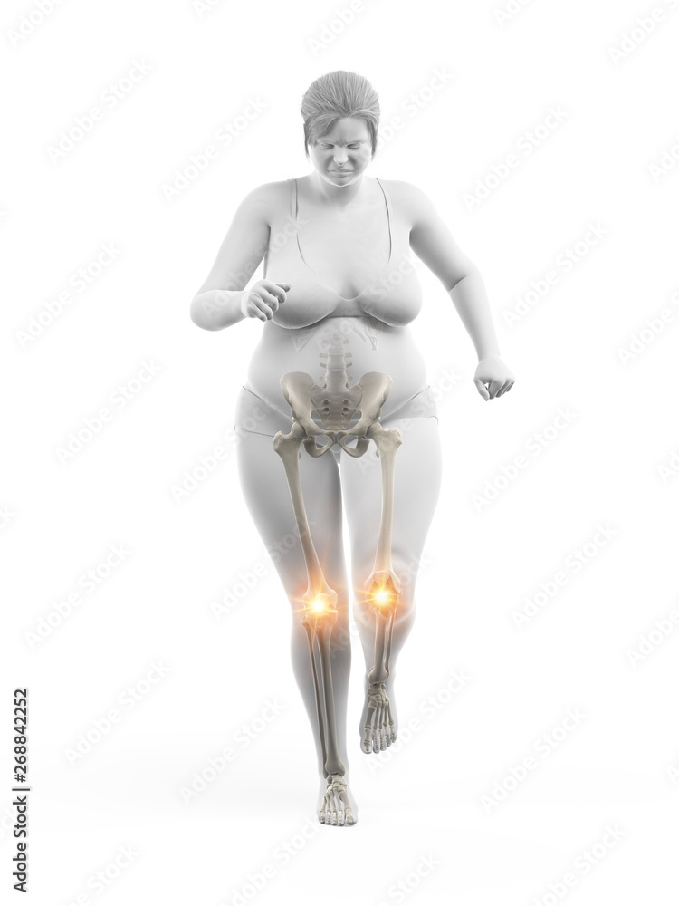3d rendered medically accurate illustration of an overweight womans painful knees
