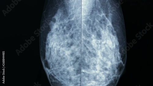 Zoom-in della lastra radiografica mammography, for breast cancer prevention.