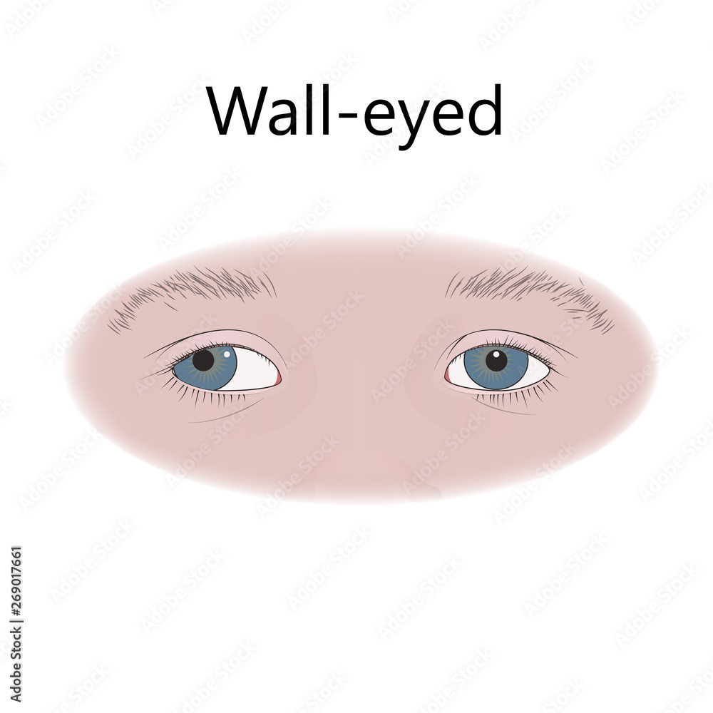 Strabismus in infants, child, kid. Walleyed, exotropia, outward eyes