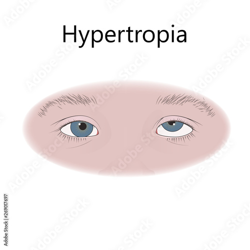 Strabismus in infants  child  kid. Hypertropia  upward eyes. Vector flat medical illustration.