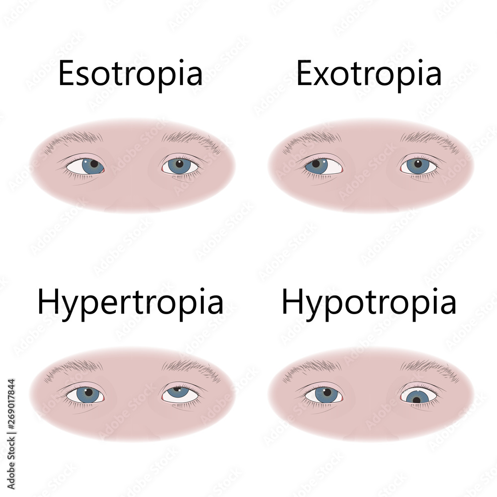 Strabismus types in infants, child, kid. Crosseyed, esotropia, inward