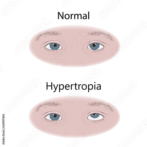 Strabismus in infants, child, kid. Hypertropia, upward eyes. Comparison with normal. Vector flat medical illustration.
