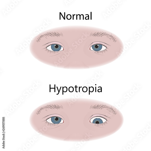 Strabismus in infants, child, kid. Hypotropia, downward eyes. Comparison with normal. Vector flat medical illustration.