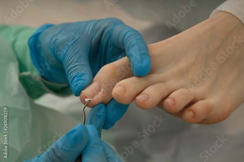 Podologist making procedure with nails. Podology. Footcare