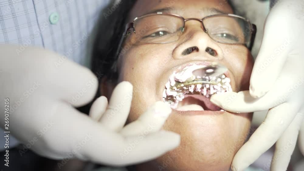 Dental impression being taken using a perforated tray for removable