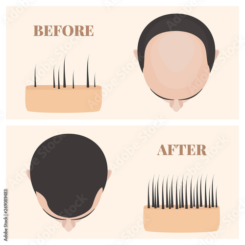 Man with thinning hair before and after hair loss. Male pattern baldness set with skin cross-section diagram. Treatment result in top view. Alopecia infographics medical vector template for clinics.