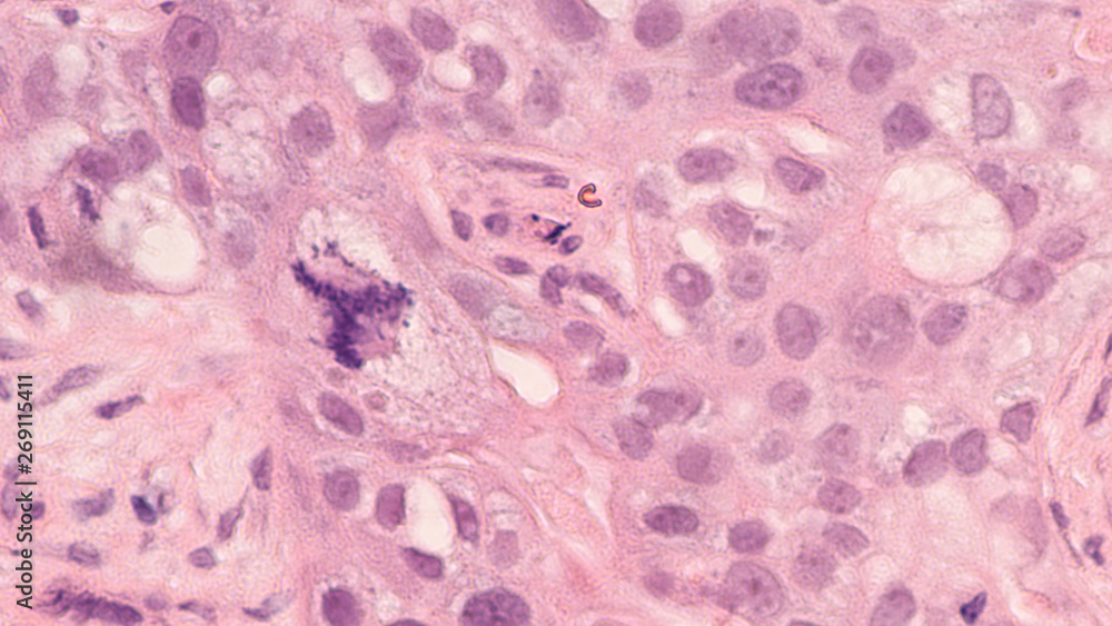 Microscopic image showing a tripolar atypical mitosis in a poorly