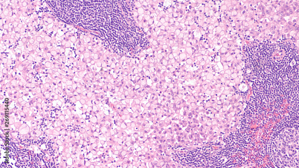 Microscopic image (photomicrograph) of a poorly differentiated gastric ...
