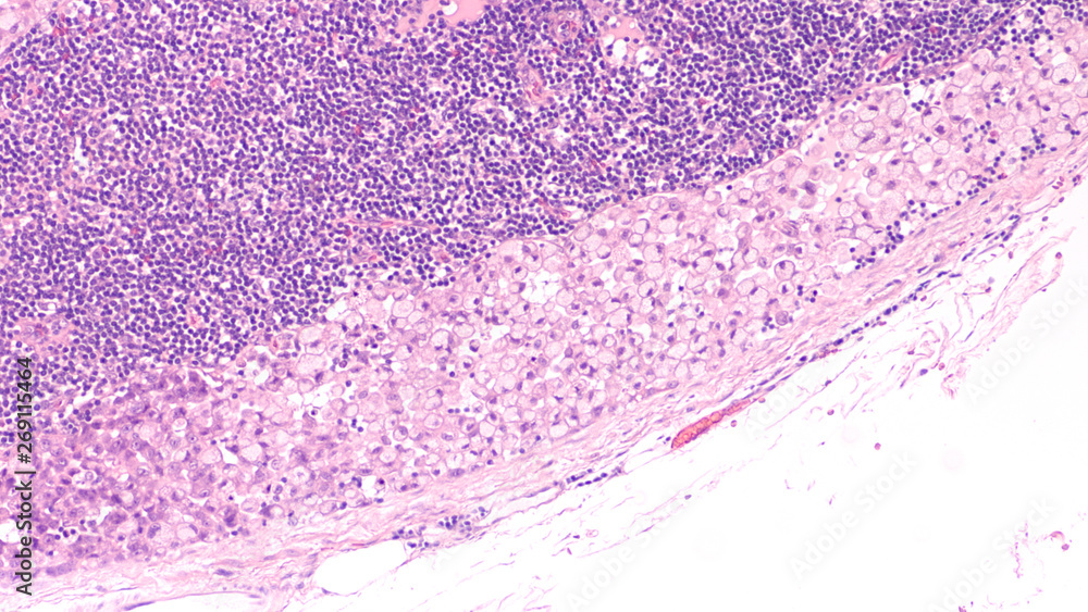 Microscopic image (photomicrograph) of a poorly differentiated gastric ...