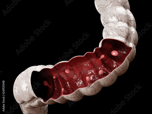 Colon polyps. 3d illustration, Polyp in the intestine. photo