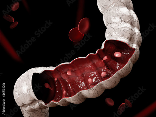 Colon polyps. 3d illustration, Polyp in the intestine.