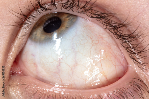 Photography Red veins in the eye of a boy, Macro