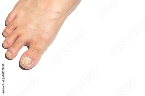 Nail disease. Close up view on white background with clipping path and blank space for text or design photo