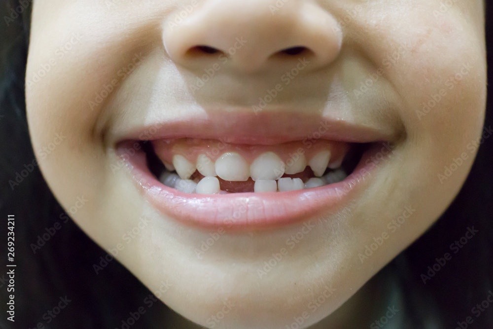 close up little girl showing lost a tooth close up little girl showing lost a tooth
