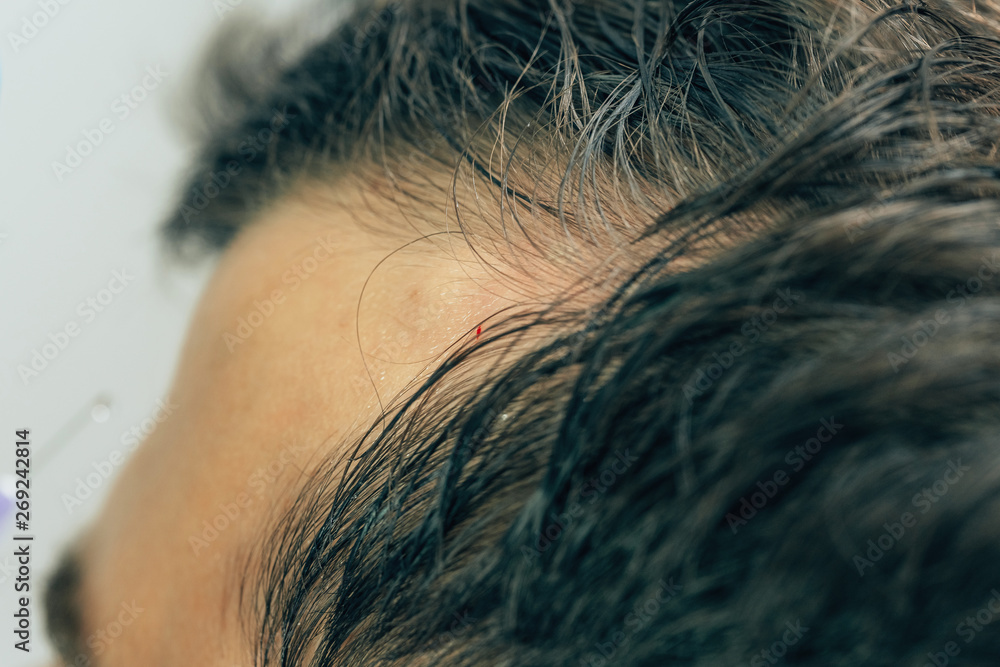 A bald spot on the forehead of a young man. The texture of the rare hair on  the head of a man. Male pattern baldness. Fighting hair loss in men. Stock  Photo |