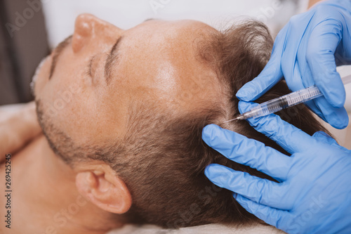 Close up of a mature man receiving hairloss treatment injections in scalp by professional trichologist. Dermatologist doing scalp injections for mature male client with alopecia problem