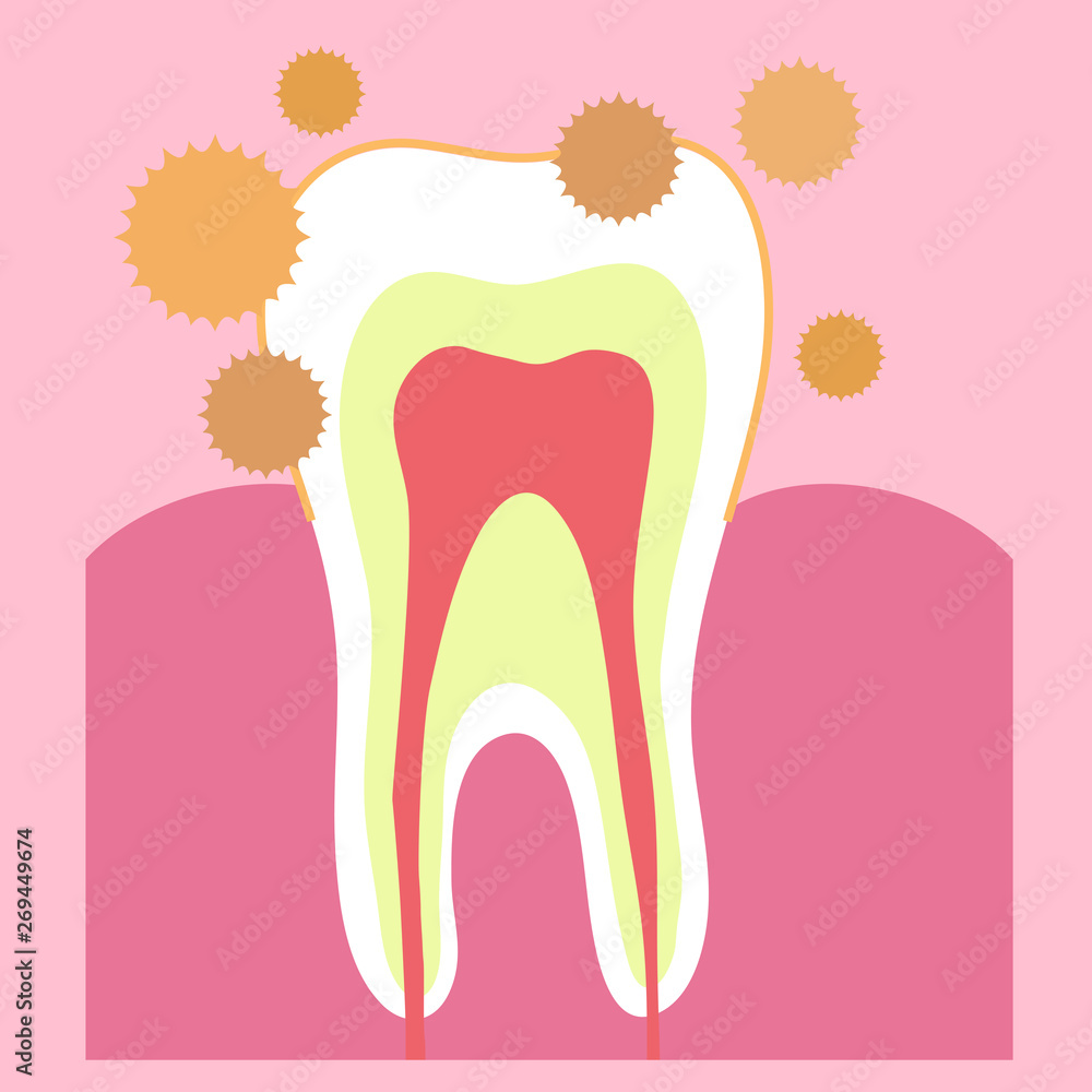 Tooth and bacteria on a pink background. Vector illustration. Tooth and bacteria on a pink background. Vector illustration.