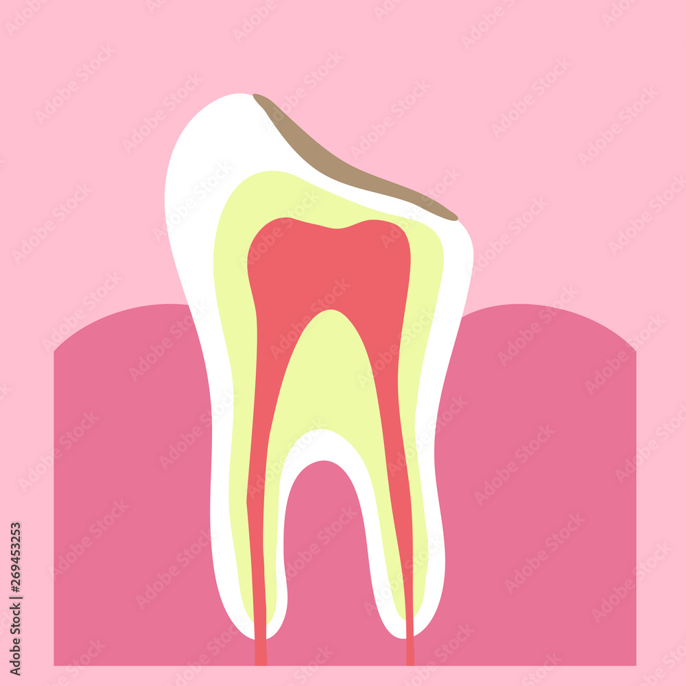 Tooth and caries on it in the background. Dentistry Vector illustration. Tooth and caries on it in the background. Dentistry Vector illustration.
