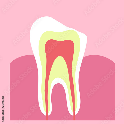 Tooth and chip on it on a pink background. Vector illustration. 
