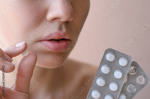 Part of a young woman's face with a virus herpes simplex on lips, treatment with pills photo