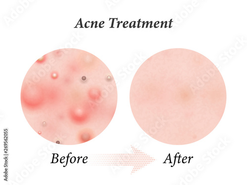 Skin acne treatment before and after. Vector skin acne pimples, facial cleanser and face cosmetic package design