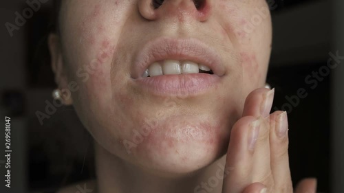 woman with a Allergy on the face, dermatitis photo