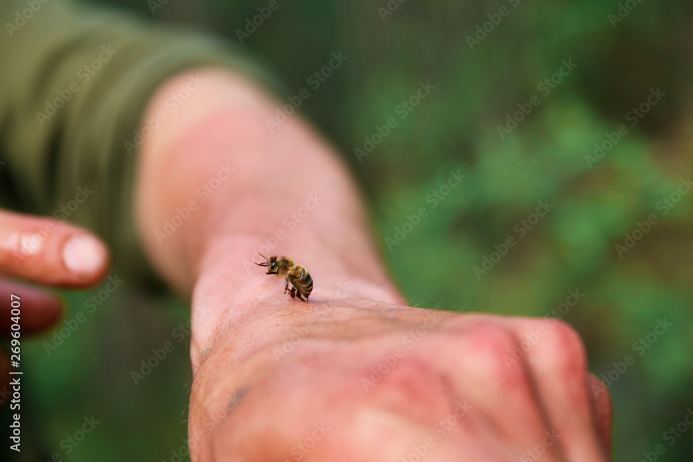 bee sting. a bee stung a man and left a sting in his hand