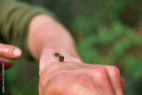 bee sting. a bee stung a man and left a sting in his hand