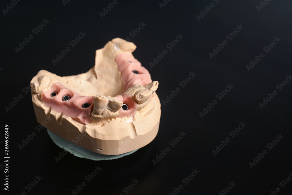 Obraz premium Dental jaw cast model and dental equipment on black background, concept medical image of dental healtcare, dental hygiene