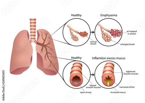 Chronic Obstructive Pulmonary Disease illustration