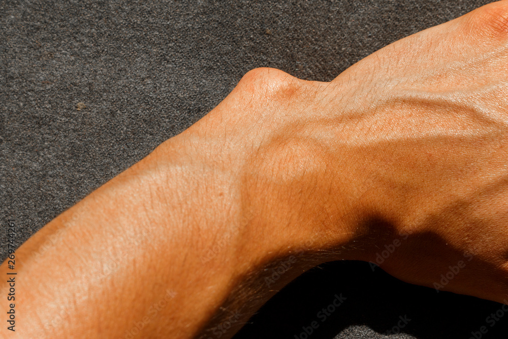 deformity of hand because of Maffucci syndrome. valgus deformity of the