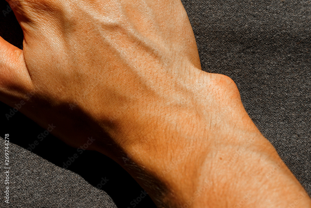 The bulging bone on the right hand that requires surgery. bulging bone