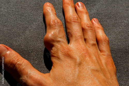 finger with arthritis of the male hand. Rheumatoid arthritis hands Isolated on white background photo