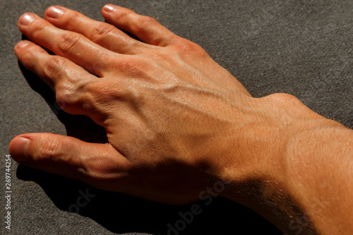 tumor on the finger caused by Ollier disease. man hand on the gray background.