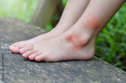 Close up Allergic skin from mosquito bite on little girl leg when her playing in playground park