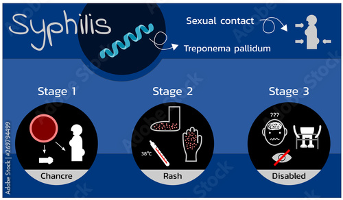 Foto Stages of Syphilis disease , infographic vector
