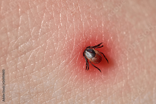 Foto Sucking tick Macro photo on human skin