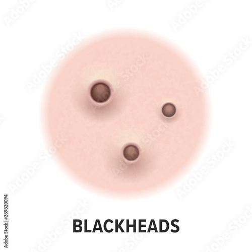 Blackheads skin acne type vector icon. Skin disease acne blackheads pimples type and face pore comedones