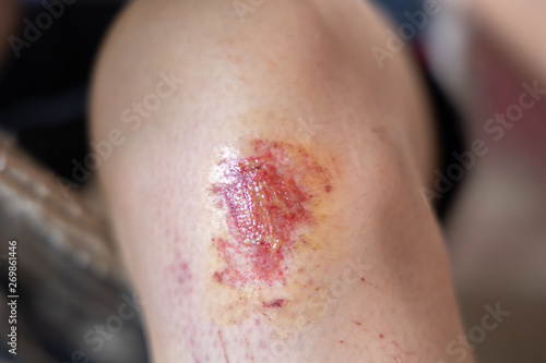 Quadro em tela Bruise wound on woman's knee